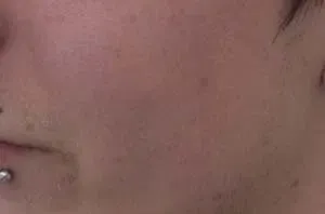 Na behandeling - moedervlekken verwijderd