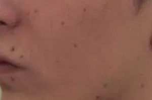 Voor behandeling - moedervlekken op gezicht