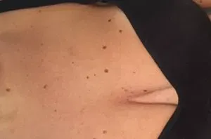 Voor behandeling - moedervlekken op lichaam