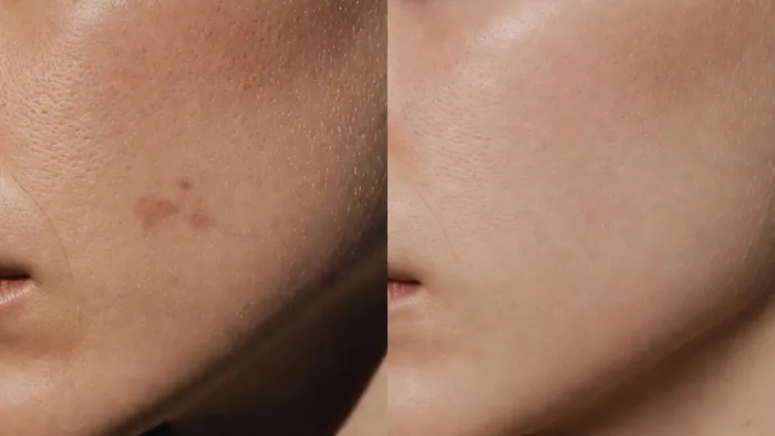 Moedervlek laseren voor en na resultaat 2026 - wang close-up geen litteken