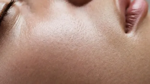 Shave excisie verheven moedervlek verwijderen 1 behandeling - bolle moedervlek afschaven zonder hechtingen